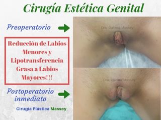 Labioplastia de Reducción de Labios Menores, y aumento de Labios Mayores con grasa