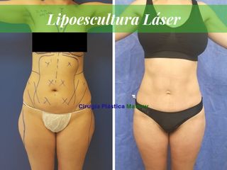 Lipoescultura Láser 