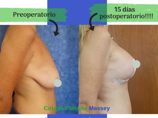 Mastopexia en T invertida con prótesis