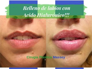 Relleno labios con Ácido Hialurónico