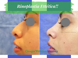 Rinoplastia (Cirugía Estética de Nariz)