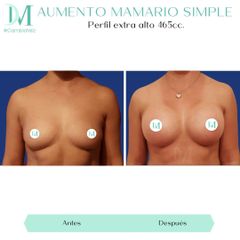 Aumento mamario - Cirugía Plástica Massey