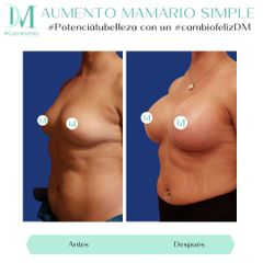 Aumento mamario - Cirugía Plástica Massey