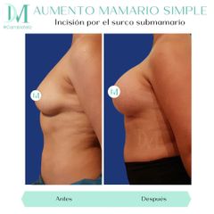 Aumento mamario - Cirugía Plástica Massey