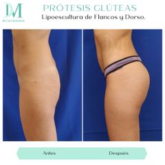 Prótesis glúteas - Cirugía Plástica Massey