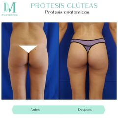 Prótesis glúteas - Cirugía Plástica Massey