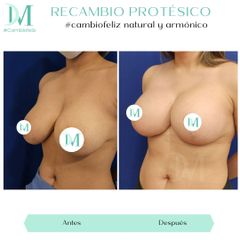 Mastopexia - Cirugía Plástica Massey