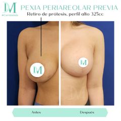 Mastopexia - Cirugía Plástica Massey