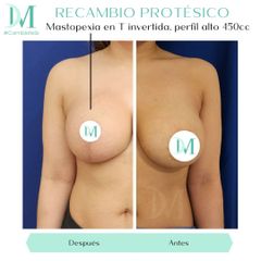 Mastopexia - Cirugía Plástica Massey