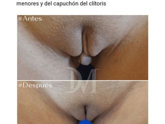 Vaginoplastia antes y después - 831567