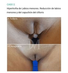 Cirugía Genital Femenina - Cirugía Plástica Massey