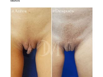 Labioplastia antes y después - 831568