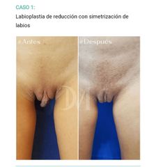 Cirugía Genital Femenina - Cirugía Plástica Massey