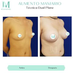 Aumento mamario - Cirugía Plástica Massey