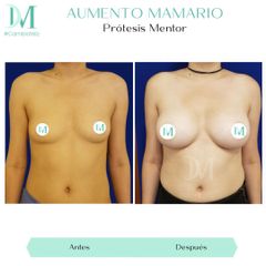 Aumento mamario - Cirugía Plástica Massey