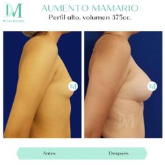 Aumento mamario - Cirugía Plástica Massey