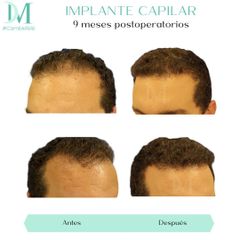 Implante capilar - Cirugía Plástica Massey