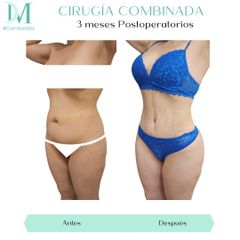 Dermolipectomía más lipoescultura - Cirugía Plástica Massey