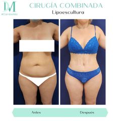 Dermolipectomía más lipoescultura - Cirugía Plástica Massey