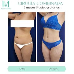 Dermolipectomía más lipoescultura - Cirugía Plástica Massey