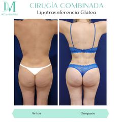 Dermolipectomía más lipoescultura - Cirugía Plástica Massey