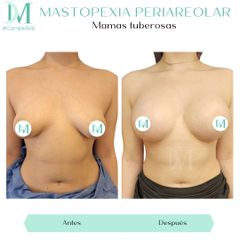 Mamas tuberosas - Cirugía Plástica Massey
