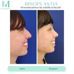 Rinoplastia - Cirugía Plástica Massey