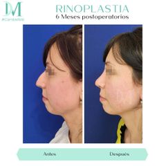 Rinoplastia - Cirugía Plástica Massey