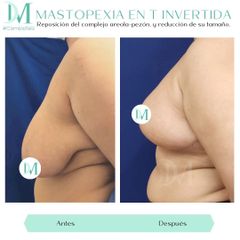 Mastopexia - Cirugía Plástica Massey