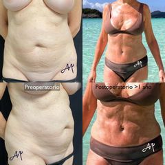Abdominoplastia + Recambio Prótesis - Dr. Alejandro J Merello Abente