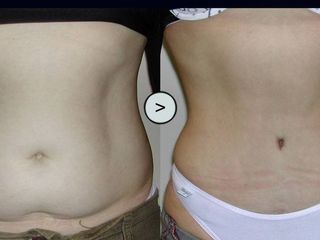 Abdominoplastia