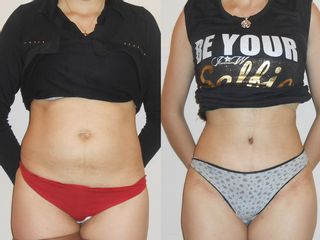 Abdominoplastiay lipo