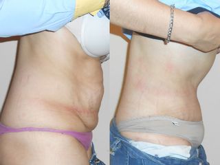 Abdominoplastia y lipo