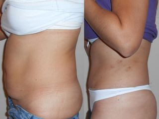 Abdominoplastia y lipo