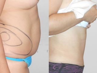 Abdominoplastia y lipo