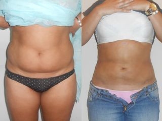 Lipo