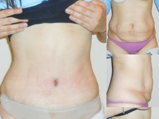 Abdominoplastía y corrección de eventración