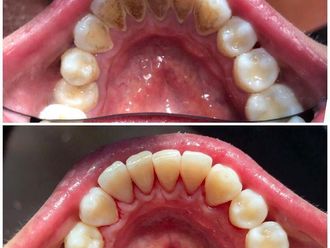 Limpieza dental - 854802