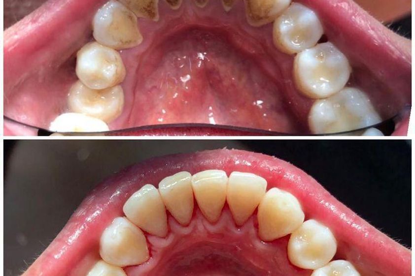 Limpieza dental antes y después - 854802