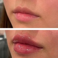 Relleno de labios - Dra. Paola León