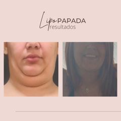 Lipopapada - Dra. Paola León