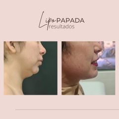 Lipopapada - Dra. Paola León