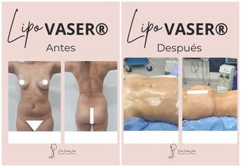Liposucción - Dr. Luis Felipe Borda