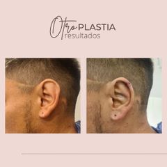 Otoplastia - Dra. Paola León