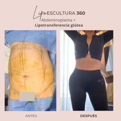 Lipoescultura - Dra. Paola León