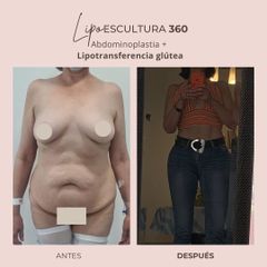 Lipoescultura - Dra. Paola León