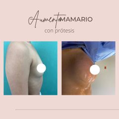 Aumento mamas - Dra. Paola León
