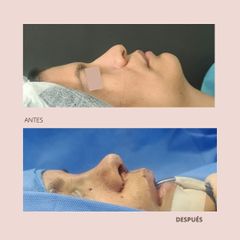 Rinoplastia - Dra. Paola León