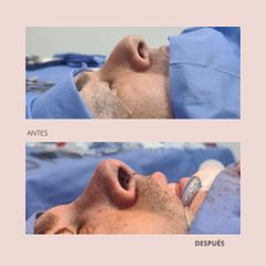 Rinoplastia - Dra. Paola León