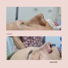 Rinoplastia - Dra. Paola León